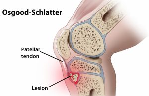 Osgood Schlatters Disease - physiotherapy management