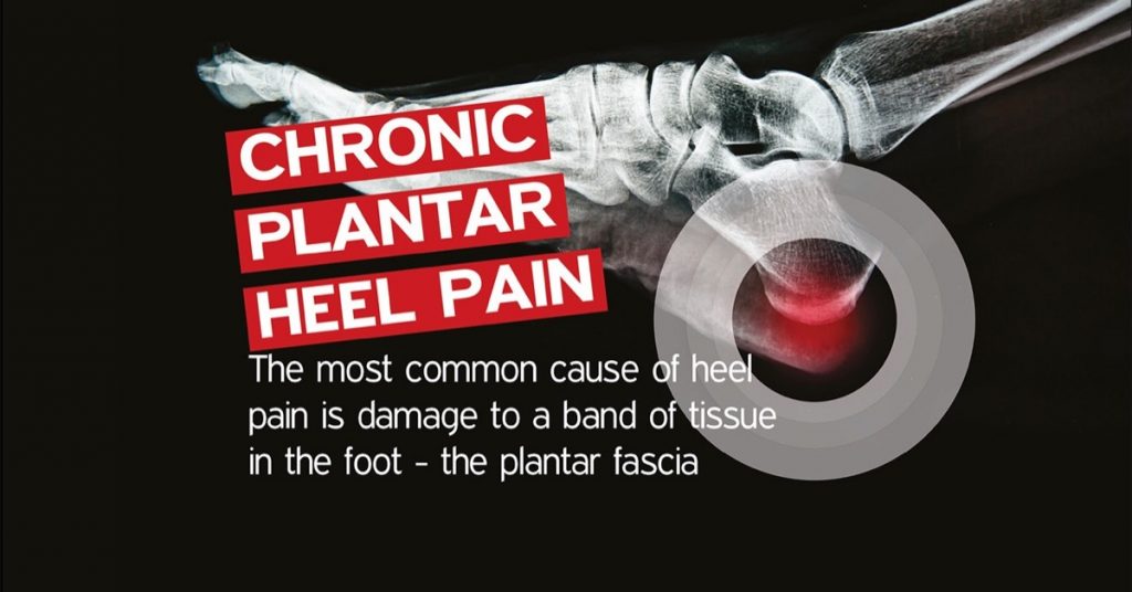 Chronic Plantar Heel Pain
